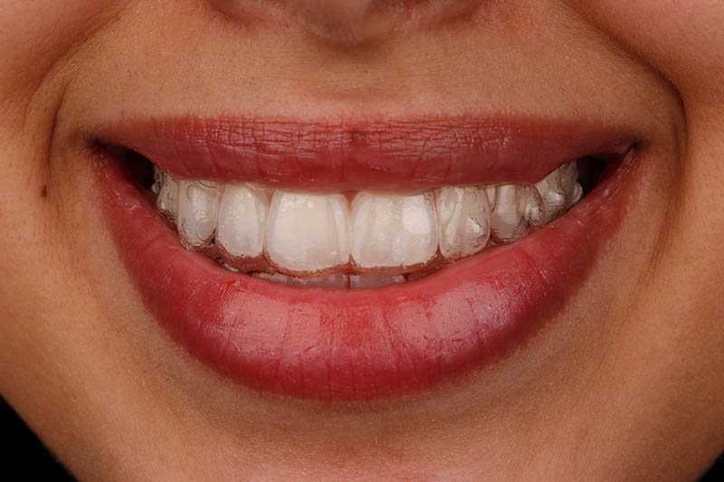 invisalign invisible braces