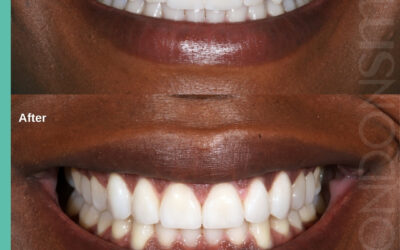 Cosmetic Dentistry London: Building Great Smiles