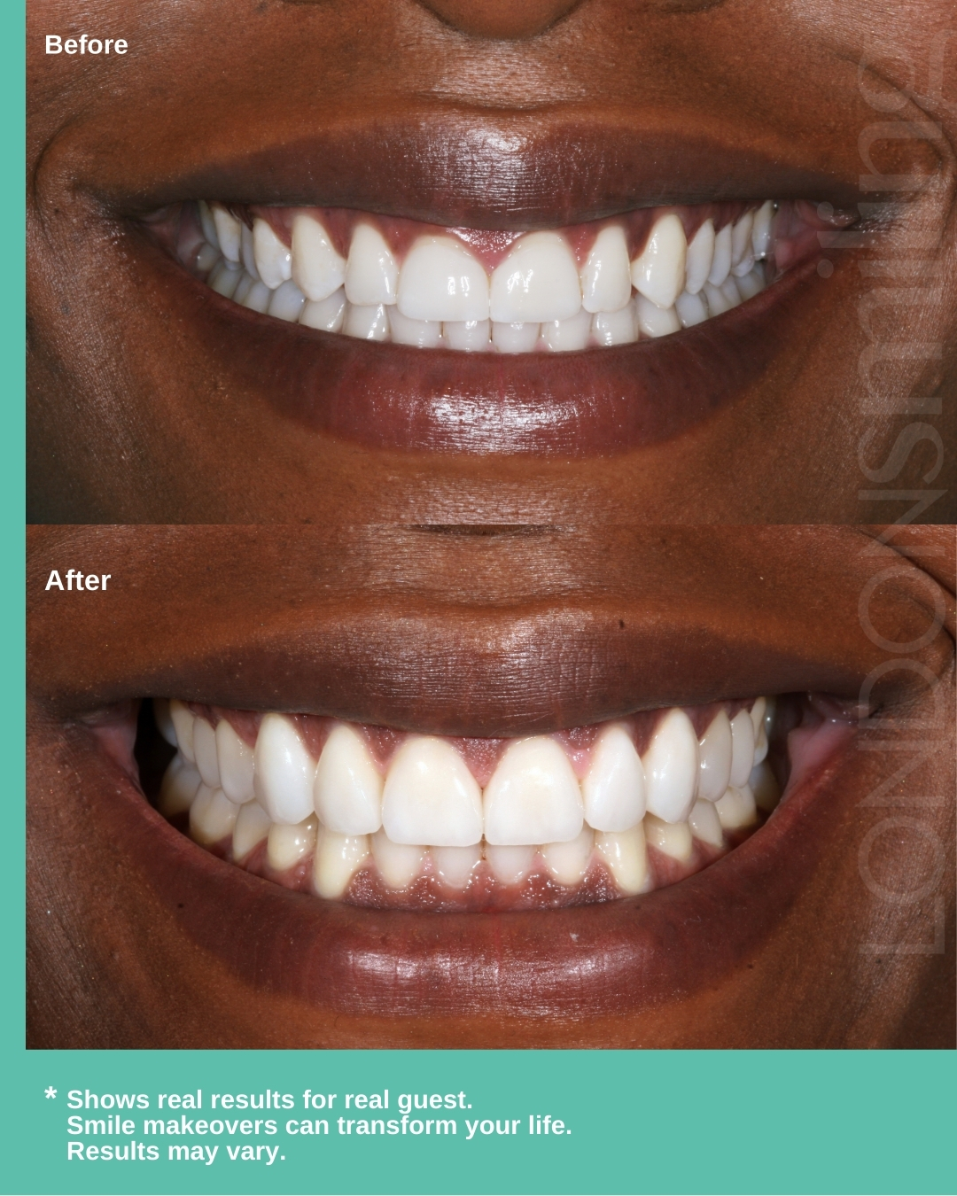 Before-and-after image showing a smile transformation. Above is the “Before” displaying the original smile. On the bottom, “After” reveals a visibly aligned smile after ten veneers, appearing more aligned.