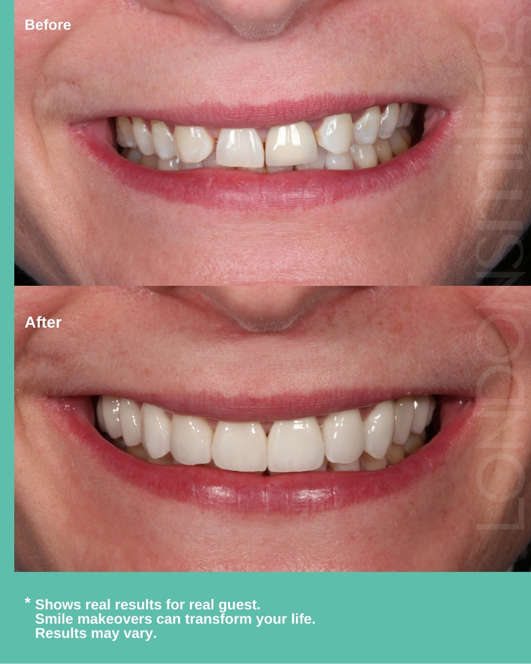Before-and-after image of a smile makeover using Invisalign and ten porcelain veneers. On the top, “Before” shows the original smile. On the bottom, “After” reveals a straightened, aligned smile with new porcelain veneers that appear bright and uniform. Text overlay reads: “Shows real results for real guest. Smile makeovers can transform your life. Results may vary.”