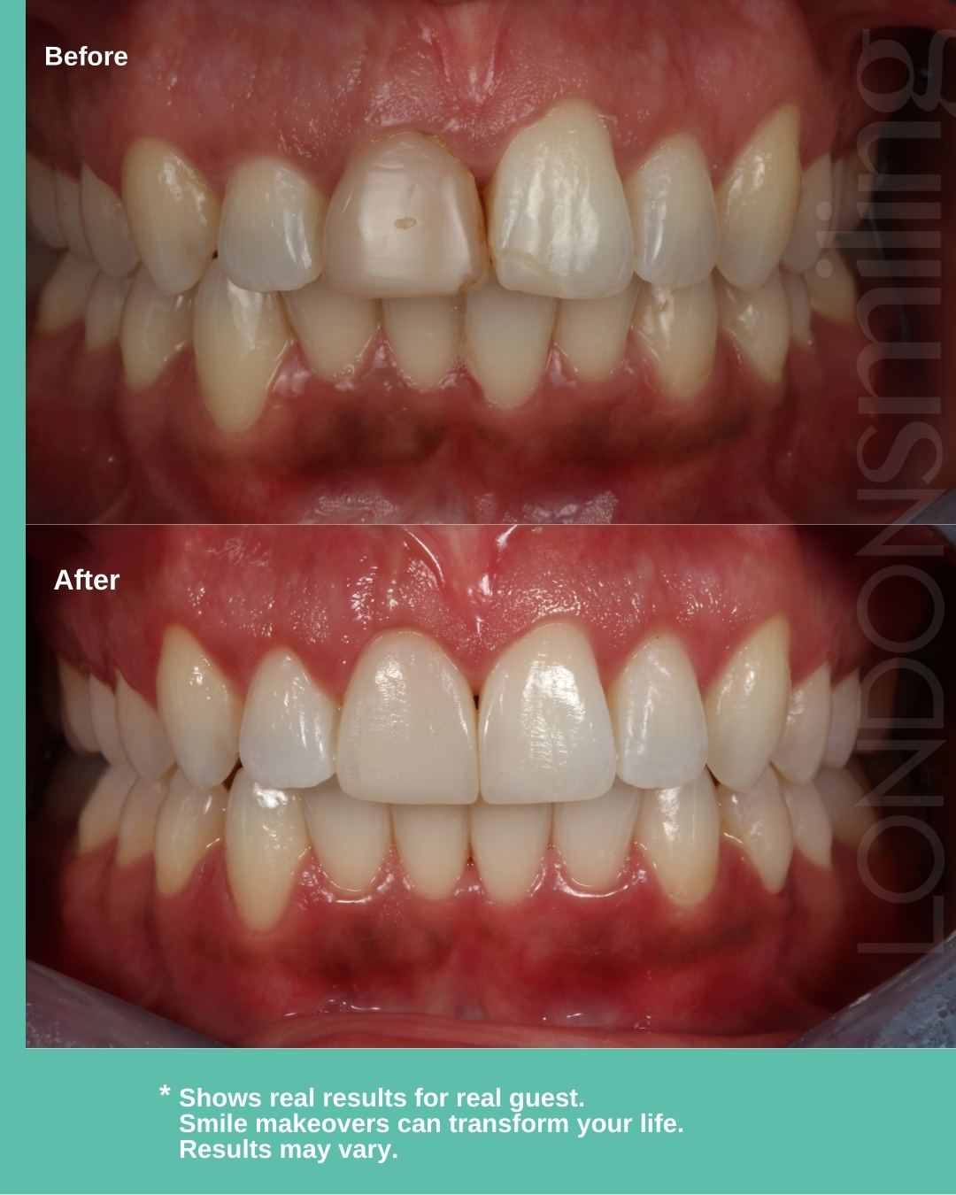 Before & after: Invisalign and bonding create a beautifully aligned, natural smile