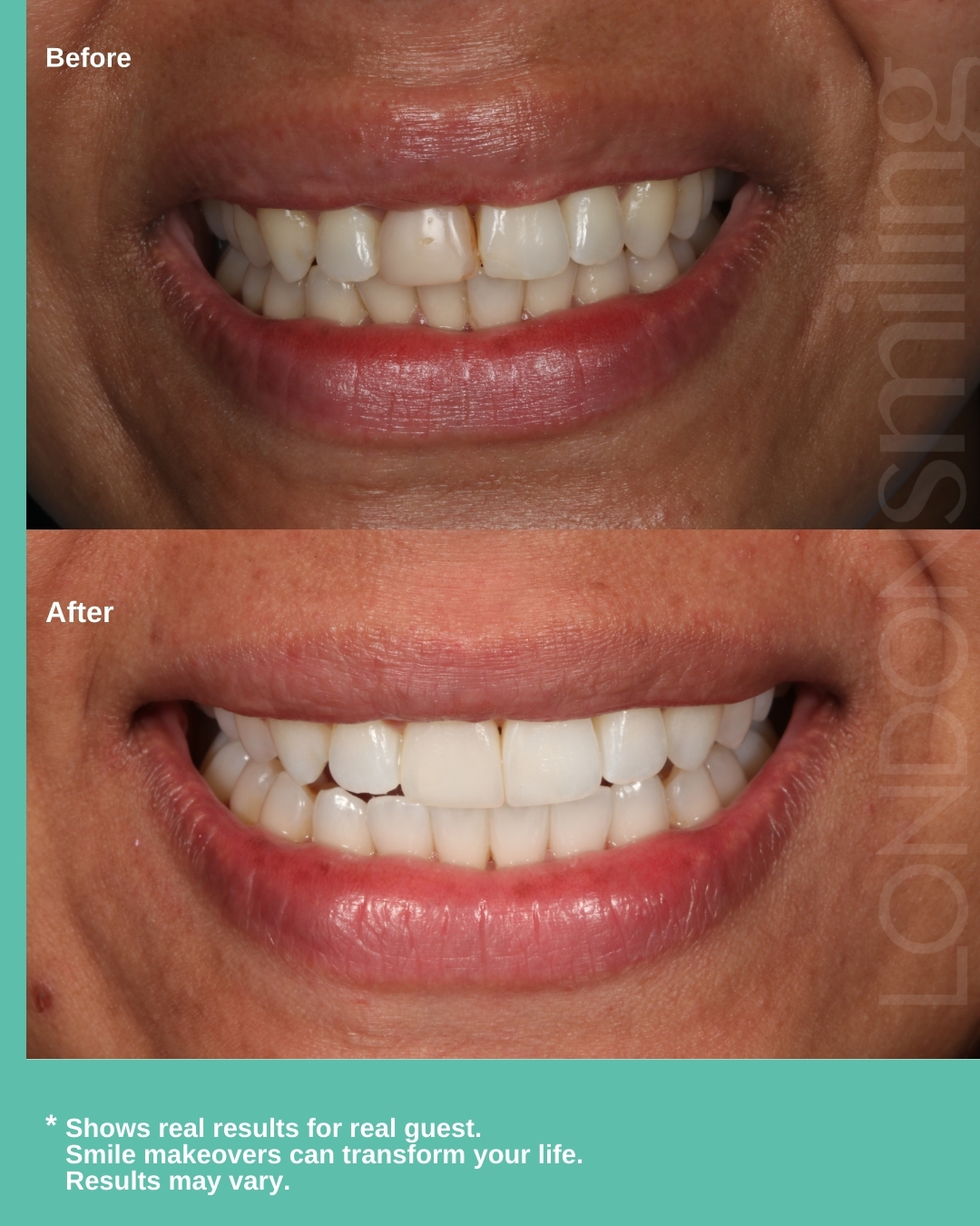 Before & after: Invisalign and bonding create a beautifully aligned, natural smile