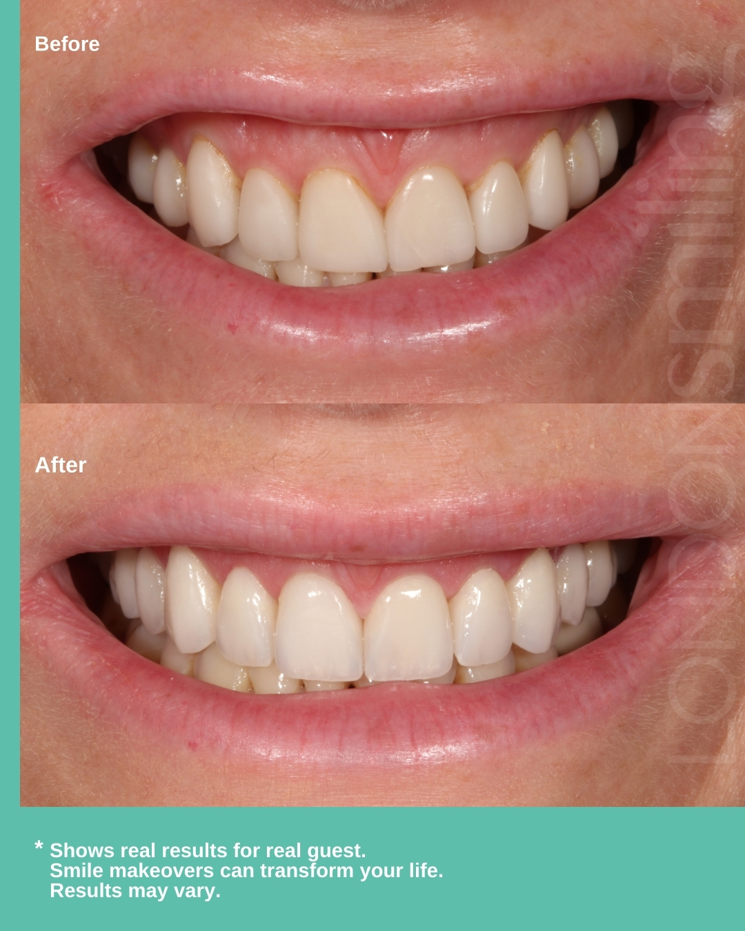 Before & after: a smile transformed with ten new porcelain veneers